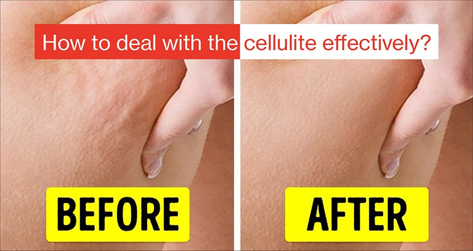 How to deal with the cellulite effectively?